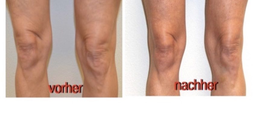 Knie Straffung Medical Beauty Concept